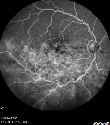 Branch Retinal Vein Occlusion and worsened cystoid macular edema following cataract surgery
51 year old female The patient noticed gradual vision loss in both eyes starting possibly after her last cataract surgery in May of 2022 (3 months ago). She had ECCE 3/2022 OD and 5/2022 OS.  She does not have diabetes. She had glaucoma shunts placed about 2017.  She has been on latanoprost and timolol.  She is now getting ready to start Combigan and Bromfenac.  She is also staring xidra for dry eye.  She stopped the latanorpost on 8/15/22.  She has had macular edema before for which she had intraocular injections which worked.  She has had no injections lately. When she was getting treated for macular edema in the past she had an IOP of 60. 
Medical Hx: Hypertension, Systemic. Glaucoma. Arthritis. Vertigo. Stroke. 
Systemic Meds: Trimfya. NAPROXEN. LISINOPRIL. 
VA OD: sc20/63-1 
VA OS: sc20/50 
IOP: TP: OD:12 OS:12
