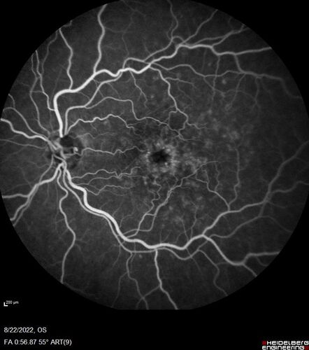 Branch Retinal Vein Occlusion and worsened cystoid macular edema following cataract surgery
51 year old female The patient noticed gradual vision loss in both eyes starting possibly after her last cataract surgery in May of 2022 (3 months ago). She had ECCE 3/2022 OD and 5/2022 OS.  She does not have diabetes. She had glaucoma shunts placed about 2017.  She has been on latanoprost and timolol.  She is now getting ready to start Combigan and Bromfenac.  She is also staring xidra for dry eye.  She stopped the latanorpost on 8/15/22.  She has had macular edema before for which she had intraocular injections which worked.  She has had no injections lately. When she was getting treated for macular edema in the past she had an IOP of 60. 
Medical Hx: Hypertension, Systemic. Glaucoma. Arthritis. Vertigo. Stroke. 
Systemic Meds: Trimfya. NAPROXEN. LISINOPRIL. 
VA OD: sc20/63-1 
VA OS: sc20/50 
IOP: TP: OD:12 OS:12
