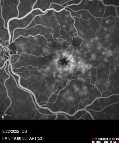 Branch Retinal Vein Occlusion and worsened cystoid macular edema following cataract surgery
51 year old female The patient noticed gradual vision loss in both eyes starting possibly after her last cataract surgery in May of 2022 (3 months ago). She had ECCE 3/2022 OD and 5/2022 OS.  She does not have diabetes. She had glaucoma shunts placed about 2017.  She has been on latanoprost and timolol.  She is now getting ready to start Combigan and Bromfenac.  She is also staring xidra for dry eye.  She stopped the latanorpost on 8/15/22.  She has had macular edema before for which she had intraocular injections which worked.  She has had no injections lately. When she was getting treated for macular edema in the past she had an IOP of 60. 
Medical Hx: Hypertension, Systemic. Glaucoma. Arthritis. Vertigo. Stroke. 
Systemic Meds: Trimfya. NAPROXEN. LISINOPRIL. 
VA OD: sc20/63-1 
VA OS: sc20/50 
IOP: TP: OD:12 OS:12
