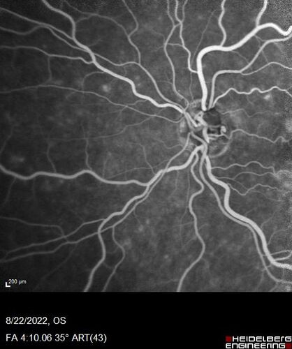 Branch Retinal Vein Occlusion and worsened cystoid macular edema following cataract surgery
51 year old female The patient noticed gradual vision loss in both eyes starting possibly after her last cataract surgery in May of 2022 (3 months ago). She had ECCE 3/2022 OD and 5/2022 OS.  She does not have diabetes. She had glaucoma shunts placed about 2017.  She has been on latanoprost and timolol.  She is now getting ready to start Combigan and Bromfenac.  She is also staring xidra for dry eye.  She stopped the latanorpost on 8/15/22.  She has had macular edema before for which she had intraocular injections which worked.  She has had no injections lately. When she was getting treated for macular edema in the past she had an IOP of 60. 
Medical Hx: Hypertension, Systemic. Glaucoma. Arthritis. Vertigo. Stroke. 
Systemic Meds: Trimfya. NAPROXEN. LISINOPRIL. 
VA OD: sc20/63-1 
VA OS: sc20/50 
IOP: TP: OD:12 OS:12
