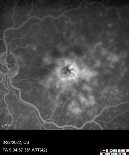 Branch Retinal Vein Occlusion and worsened cystoid macular edema following cataract surgery
51 year old female The patient noticed gradual vision loss in both eyes starting possibly after her last cataract surgery in May of 2022 (3 months ago). She had ECCE 3/2022 OD and 5/2022 OS.  She does not have diabetes. She had glaucoma shunts placed about 2017.  She has been on latanoprost and timolol.  She is now getting ready to start Combigan and Bromfenac.  She is also staring xidra for dry eye.  She stopped the latanorpost on 8/15/22.  She has had macular edema before for which she had intraocular injections which worked.  She has had no injections lately. When she was getting treated for macular edema in the past she had an IOP of 60. 
Medical Hx: Hypertension, Systemic. Glaucoma. Arthritis. Vertigo. Stroke. 
Systemic Meds: Trimfya. NAPROXEN. LISINOPRIL. 
VA OD: sc20/63-1 
VA OS: sc20/50 
IOP: TP: OD:12 OS:12
