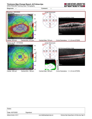 Branch Retinal Vein Occlusion and worsened cystoid macular edema following cataract surgery
51 year old female The patient noticed gradual vision loss in both eyes starting possibly after her last cataract surgery in May of 2022 (3 months ago). She had ECCE 3/2022 OD and 5/2022 OS.  She does not have diabetes. She had glaucoma shunts placed about 2017.  She has been on latanoprost and timolol.  She is now getting ready to start Combigan and Bromfenac.  She is also staring xidra for dry eye.  She stopped the latanorpost on 8/15/22.  She has had macular edema before for which she had intraocular injections which worked.  She has had no injections lately. When she was getting treated for macular edema in the past she had an IOP of 60. 
Medical Hx: Hypertension, Systemic. Glaucoma. Arthritis. Vertigo. Stroke. 
Systemic Meds: Trimfya. NAPROXEN. LISINOPRIL. 
VA OD: sc20/63-1 
VA OS: sc20/50 
IOP: TP: OD:12 OS:12
