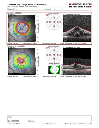 Branch Retinal Vein Occlusion and worsened cystoid macular edema following cataract surgery
51 year old female The patient noticed gradual vision loss in both eyes starting possibly after her last cataract surgery in May of 2022 (3 months ago). She had ECCE 3/2022 OD and 5/2022 OS.  She does not have diabetes. She had glaucoma shunts placed about 2017.  She has been on latanoprost and timolol.  She is now getting ready to start Combigan and Bromfenac.  She is also staring xidra for dry eye.  She stopped the latanorpost on 8/15/22.  She has had macular edema before for which she had intraocular injections which worked.  She has had no injections lately. When she was getting treated for macular edema in the past she had an IOP of 60. 
Medical Hx: Hypertension, Systemic. Glaucoma. Arthritis. Vertigo. Stroke. 
Systemic Meds: Trimfya. NAPROXEN. LISINOPRIL. 
VA OD: sc20/63-1 
VA OS: sc20/50 
IOP: TP: OD:12 OS:12
