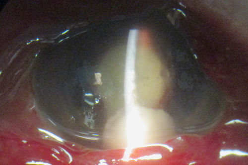 Streptococcus mitis Endophthalmitis following Intravitreal Avastin for wet AMD
88 Year Old Man treated with Avastin 02/28/13.  Next day developed pain and severe vision loss.  Treated with Intravitreal Vancomycin 1mg/0.1 cc; Ceftazidime 2mg/0.1cc; Decadron 0.4mg/0.1cc.  Heavy growth Strep 2 days later from culture. Reinjected with Vancomycin 2 days after first Vancomyin.  Now seeing Light Perception.

