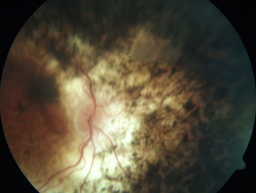 Enhanced S Cone Syndrome - Goldmann Favre - NR2E3 Mutation
82 year old man with poor vision for many years.  VA HM OD, 5/200 OS. Diagnosed at age 12 with retinitis pigmentosa. Nystagmus.
