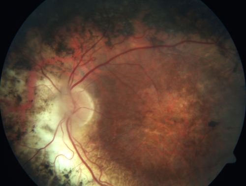 Enhanced S Cone Syndrome - Goldmann Favre - NR2E3 Mutation
82 year old man with poor vision for many years.  VA HM OD, 5/200 OS. Diagnosed at age 12 with retinitis pigmentosa. Nystagmus.
