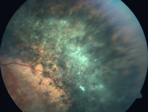 Enhanced S Cone Syndrome - Goldmann Favre - NR2E3 Mutation
82 year old man with poor vision for many years.  VA HM OD, 5/200 OS. Diagnosed at age 12 with retinitis pigmentosa. Nystagmus.

