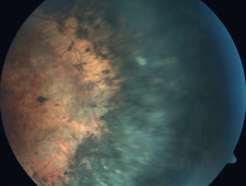 Enhanced S Cone Syndrome - Goldmann Favre - NR2E3 Mutation
82 year old man with poor vision for many years.  VA HM OD, 5/200 OS. Diagnosed at age 12 with retinitis pigmentosa. Nystagmus.
