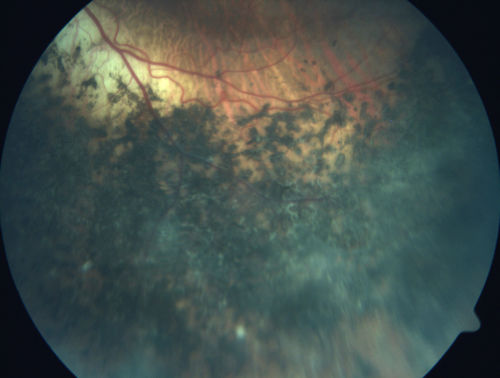 Enhanced S Cone Syndrome - Goldmann Favre - NR2E3 Mutation
82 year old man with poor vision for many years.  VA HM OD, 5/200 OS. Diagnosed at age 12 with retinitis pigmentosa. Nystagmus.
