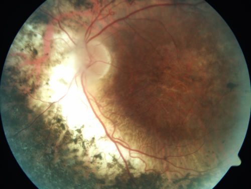 Enhanced S Cone Syndrome - Goldmann Favre - NR2E3 Mutation
82 year old man with poor vision for many years.  VA HM OD, 5/200 OS. Diagnosed at age 12 with retinitis pigmentosa. Nystagmus.
