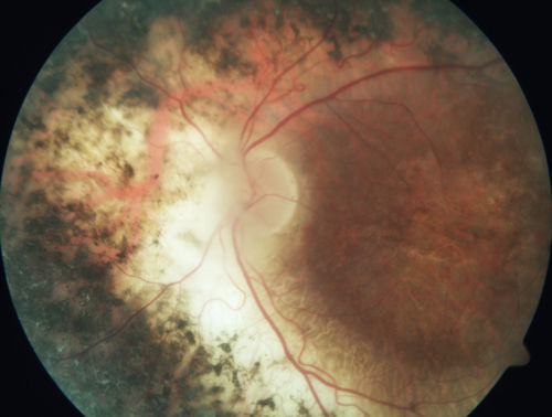 Enhanced S Cone Syndrome - Goldmann Favre - NR2E3 Mutation
82 year old man with poor vision for many years.  VA HM OD, 5/200 OS. Diagnosed at age 12 with retinitis pigmentosa. Nystagmus.
