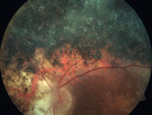 Enhanced S Cone Syndrome - Goldmann Favre - NR2E3 Mutation
82 year old man with poor vision for many years.  VA HM OD, 5/200 OS. Diagnosed at age 12 with retinitis pigmentosa. Nystagmus.
