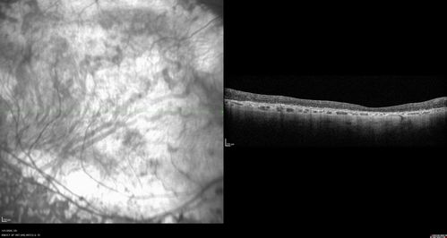 Enhanced S Cone Syndrome - Goldmann Favre - NR2E3 Mutation
82 year old man with poor vision for many years.  VA HM OD, 5/200 OS. Diagnosed at age 12 with retinitis pigmentosa. Nystagmus.
