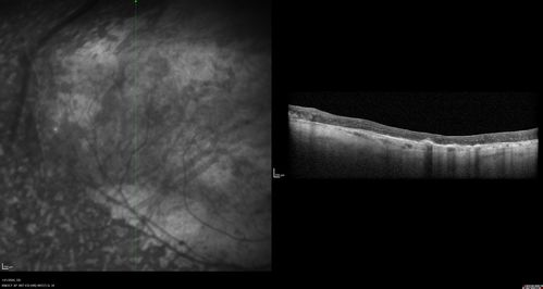Enhanced S Cone Syndrome - Goldmann Favre - NR2E3 Mutation
82 year old man with poor vision for many years.  VA HM OD, 5/200 OS. Diagnosed at age 12 with retinitis pigmentosa. Nystagmus.
