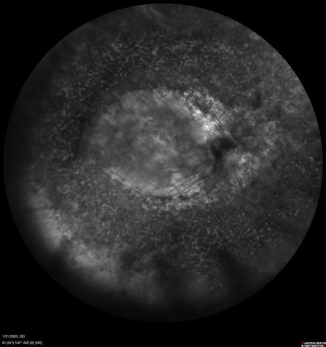 Enhanced S Cone Syndrome - Goldmann Favre - NR2E3 Mutation
82 year old man with poor vision for many years.  VA HM OD, 5/200 OS. Diagnosed at age 12 with retinitis pigmentosa. Nystagmus.
