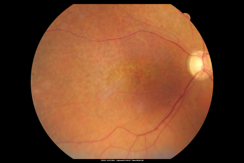 Fundus Photograph  - Enhanced S Cone Syndrome - Goldmann Favre - 
55-year-old woman  while in college her vision was poor even with glasses and she sought evaluation for that.  She was told after she had an electroretinogram at USF 15 years ago, that she had something with her blue cones.  She does have poor night vision, but her reading vision is pretty good. 

VISUAL ACUITY:  OD 20/40,  OS 20/40
