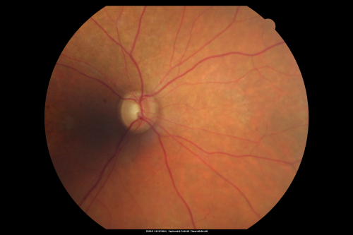 Fundus Photograph  - Enhanced S Cone Syndrome - Goldmann Favre - 
55-year-old woman  while in college her vision was poor even with glasses and she sought evaluation for that.  She was told after she had an electroretinogram at USF 15 years ago, that she had something with her blue cones.  She does have poor night vision, but her reading vision is pretty good. 

VISUAL ACUITY:  OD 20/40,  OS 20/40
