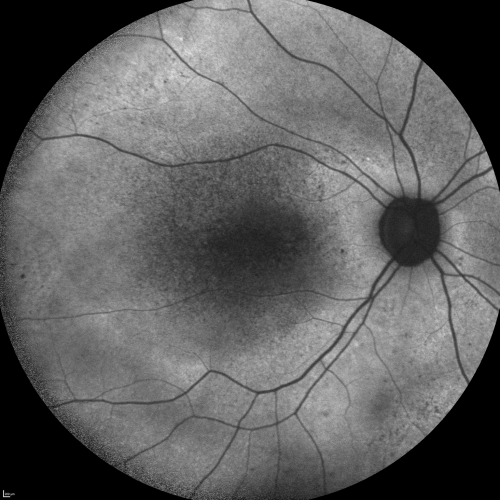 Fundus Autofluorescence  - Enhanced S Cone Syndrome - Goldmann Favre - 
55-year-old woman  while in college her vision was poor even with glasses and she sought evaluation for that.  She was told after she had an electroretinogram at USF 15 years ago, that she had something with her blue cones.  She does have poor night vision, but her reading vision is pretty good. 

VISUAL ACUITY:  OD 20/40,  OS 20/40
