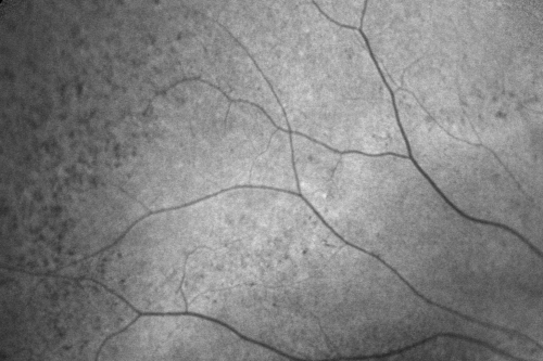 Fundus Autofluorescence  - Enhanced S Cone Syndrome - Goldmann Favre - 
55-year-old woman  while in college her vision was poor even with glasses and she sought evaluation for that.  She was told after she had an electroretinogram at USF 15 years ago, that she had something with her blue cones.  She does have poor night vision, but her reading vision is pretty good. 

VISUAL ACUITY:  OD 20/40,  OS 20/40
