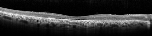 OCT Line Scan  - Enhanced S Cone Syndrome - Goldmann Favre - 
55-year-old woman  while in college her vision was poor even with glasses and she sought evaluation for that.  She was told after she had an electroretinogram at USF 15 years ago, that she had something with her blue cones.  She does have poor night vision, but her reading vision is pretty good. 

VISUAL ACUITY:  OD 20/40,  OS 20/40
