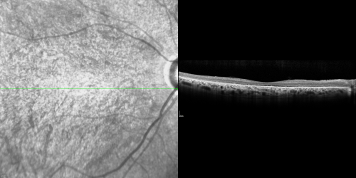 OCT Line Scan  - Enhanced S Cone Syndrome - Goldmann Favre - 
55-year-old woman  while in college her vision was poor even with glasses and she sought evaluation for that.  She was told after she had an electroretinogram at USF 15 years ago, that she had something with her blue cones.  She does have poor night vision, but her reading vision is pretty good. 

VISUAL ACUITY:  OD 20/40,  OS 20/40
