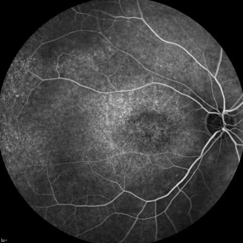 Fluorescein Angiogram  - Enhanced S Cone Syndrome - Goldmann Favre - 
55-year-old woman  while in college her vision was poor even with glasses and she sought evaluation for that.  She was told after she had an electroretinogram at USF 15 years ago, that she had something with her blue cones.  She does have poor night vision, but her reading vision is pretty good. 

VISUAL ACUITY:  OD 20/40,  OS 20/40
