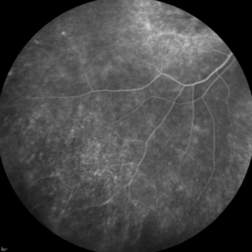 Fluorescein Angiogram  - Enhanced S Cone Syndrome - Goldmann Favre - 
55-year-old woman  while in college her vision was poor even with glasses and she sought evaluation for that.  She was told after she had an electroretinogram at USF 15 years ago, that she had something with her blue cones.  She does have poor night vision, but her reading vision is pretty good. 

VISUAL ACUITY:  OD 20/40,  OS 20/40
