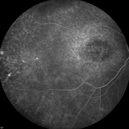 Fluorescein Angiogram  - Enhanced S Cone Syndrome - Goldmann Favre - 
55-year-old woman  while in college her vision was poor even with glasses and she sought evaluation for that.  She was told after she had an electroretinogram at USF 15 years ago, that she had something with her blue cones.  She does have poor night vision, but her reading vision is pretty good. 

VISUAL ACUITY:  OD 20/40,  OS 20/40
