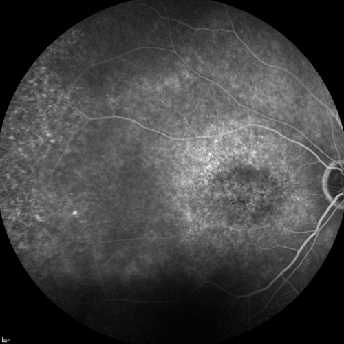 Fluorescein Angiogram  - Enhanced S Cone Syndrome - Goldmann Favre - 
55-year-old woman  while in college her vision was poor even with glasses and she sought evaluation for that.  She was told after she had an electroretinogram at USF 15 years ago, that she had something with her blue cones.  She does have poor night vision, but her reading vision is pretty good. 

VISUAL ACUITY:  OD 20/40,  OS 20/40
