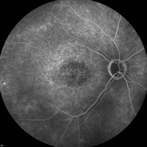 Fluorescein Angiogram  - Enhanced S Cone Syndrome - Goldmann Favre - 
55-year-old woman  while in college her vision was poor even with glasses and she sought evaluation for that.  She was told after she had an electroretinogram at USF 15 years ago, that she had something with her blue cones.  She does have poor night vision, but her reading vision is pretty good. 

VISUAL ACUITY:  OD 20/40,  OS 20/40
