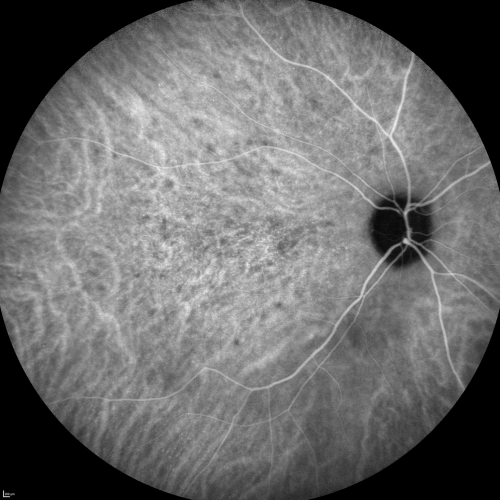 Indocyanine Green Angiogram  - Enhanced S Cone Syndrome - Goldmann Favre - 
55-year-old woman  while in college her vision was poor even with glasses and she sought evaluation for that.  She was told after she had an electroretinogram at USF 15 years ago, that she had something with her blue cones.  She does have poor night vision, but her reading vision is pretty good. 

VISUAL ACUITY:  OD 20/40,  OS 20/40
