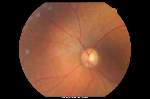 Fundus Photograph  - Enhanced S Cone Syndrome - Goldmann Favre - 
55-year-old woman  while in college her vision was poor even with glasses and she sought evaluation for that.  She was told after she had an electroretinogram at USF 15 years ago, that she had something with her blue cones.  She does have poor night vision, but her reading vision is pretty good. 

VISUAL ACUITY:  OD 20/40,  OS 20/40
