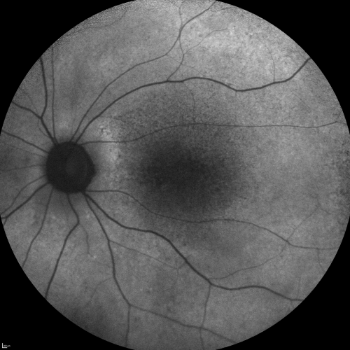 Fundus Autofluorescence  - Enhanced S Cone Syndrome - Goldmann Favre - 
55-year-old woman  while in college her vision was poor even with glasses and she sought evaluation for that.  She was told after she had an electroretinogram at USF 15 years ago, that she had something with her blue cones.  She does have poor night vision, but her reading vision is pretty good. 

VISUAL ACUITY:  OD 20/40,  OS 20/40
