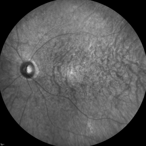 InfraRed Image  - Enhanced S Cone Syndrome - Goldmann Favre - 
55-year-old woman  while in college her vision was poor even with glasses and she sought evaluation for that.  She was told after she had an electroretinogram at USF 15 years ago, that she had something with her blue cones.  She does have poor night vision, but her reading vision is pretty good. 

VISUAL ACUITY:  OD 20/40,  OS 20/40
