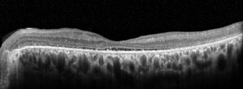 OCT Line Scan  - Enhanced S Cone Syndrome - Goldmann Favre - 
55-year-old woman  while in college her vision was poor even with glasses and she sought evaluation for that.  She was told after she had an electroretinogram at USF 15 years ago, that she had something with her blue cones.  She does have poor night vision, but her reading vision is pretty good. 

VISUAL ACUITY:  OD 20/40,  OS 20/40
