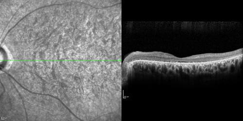 OCT Line Scan  - Enhanced S Cone Syndrome - Goldmann Favre - 
55-year-old woman  while in college her vision was poor even with glasses and she sought evaluation for that.  She was told after she had an electroretinogram at USF 15 years ago, that she had something with her blue cones.  She does have poor night vision, but her reading vision is pretty good. 

VISUAL ACUITY:  OD 20/40,  OS 20/40
