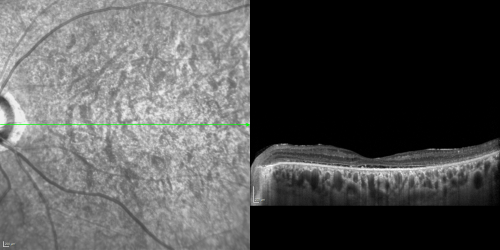 OCT Line Scan  - Enhanced S Cone Syndrome - Goldmann Favre - 
55-year-old woman  while in college her vision was poor even with glasses and she sought evaluation for that.  She was told after she had an electroretinogram at USF 15 years ago, that she had something with her blue cones.  She does have poor night vision, but her reading vision is pretty good. 

VISUAL ACUITY:  OD 20/40,  OS 20/40
