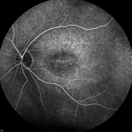 Fluorescein Angiogram  - Enhanced S Cone Syndrome - Goldmann Favre - 
55-year-old woman  while in college her vision was poor even with glasses and she sought evaluation for that.  She was told after she had an electroretinogram at USF 15 years ago, that she had something with her blue cones.  She does have poor night vision, but her reading vision is pretty good. 

VISUAL ACUITY:  OD 20/40,  OS 20/40
