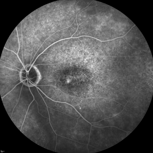 Fluorescein Angiogram  - Enhanced S Cone Syndrome - Goldmann Favre - 
55-year-old woman  while in college her vision was poor even with glasses and she sought evaluation for that.  She was told after she had an electroretinogram at USF 15 years ago, that she had something with her blue cones.  She does have poor night vision, but her reading vision is pretty good. 

VISUAL ACUITY:  OD 20/40,  OS 20/40
