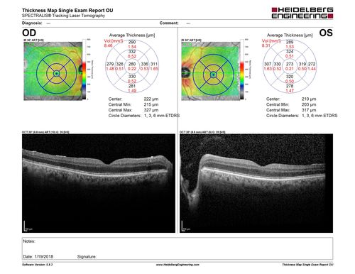 Toxic Optic Neuropathy - Ethambutol
15 months of Ethambutol with rapid vision loss OU.  VA 20/100 OD (post cataract sugery ) 20/200 OS with dense cataract.  There is temporal RNFL loss in both eyes
