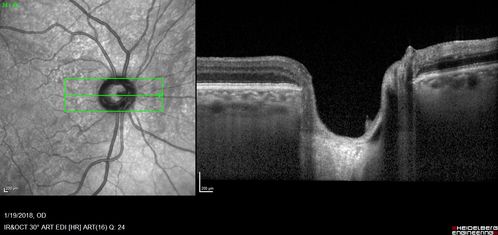 Toxic Optic Neuropathy - Ethambutol
15 months of Ethambutol with rapid vision loss OU.  VA 20/100 OD (post cataract sugery ) 20/200 OS with dense cataract.  There is temporal RNFL loss in both eyes
