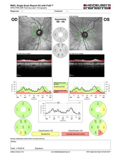 Toxic Optic Neuropathy - Ethambutol
15 months of Ethambutol with rapid vision loss OU.  VA 20/100 OD (post cataract sugery ) 20/200 OS with dense cataract.  There is temporal RNFL loss in both eyes
