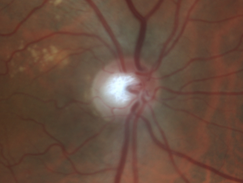 Toxic Optic Neuropathy - Ethambutol
15 months of Ethambutol with rapid vision loss OU.  VA 20/100 OD (post cataract sugery ) 20/200 OS with dense cataract.  There is temporal RNFL loss in both eyes
