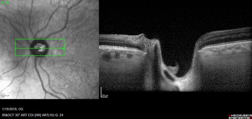 Toxic Optic Neuropathy - Ethambutol
15 months of Ethambutol with rapid vision loss OU.  VA 20/100 OD (post cataract sugery ) 20/200 OS with dense cataract.  There is temporal RNFL loss in both eyes
