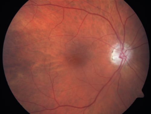 Eccentric Disciform Scar - Breakthrough Vitreous Hemorrhage - InferoTemporal Subretinal Fibrosis - Ectopic Choroidal Neovascular Membranes
88-year-old man has noticed for the last few months the vision in the right eye is foggy, like there is a film in the eye or a haze,  His vision is 20/16 in each eye. 
Right eye - inferotemporal periphery there is a hemorrhage at the equator at about 7:00 oâ€™clock, which is about 4-disc diameters across and adjacent to that there is scarring.
Left eye - large disciform scar inferotemporally
