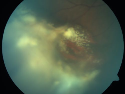 ECTOPIC DISCIFORM SCAR/PERIPHERAL CHOROIDAL NEOVASCULAR MEMBRANE â€“ EXUDATE â€“INFLAMMATION IN REACTION TO THE PERIPHERAL VASCULAR LESION 
53-year-old woman has noticed some blurred vision in the right eye for a few years.  In retrospect, she thinks it is possible since she was a teenager the right eye was always the weaker eye and that the left eye has always been the better eye.  VISUAL ACUITY:  Vision OD is 20/400
