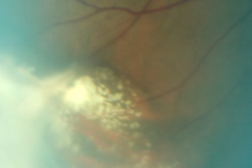 ECTOPIC DISCIFORM SCAR/PERIPHERAL CHOROIDAL NEOVASCULAR MEMBRANE â€“ EXUDATE â€“INFLAMMATION IN REACTION TO THE PERIPHERAL VASCULAR LESION 
53-year-old woman has noticed some blurred vision in the right eye for a few years.  In retrospect, she thinks it is possible since she was a teenager the right eye was always the weaker eye and that the left eye has always been the better eye.  VISUAL ACUITY:  Vision OD is 20/400
