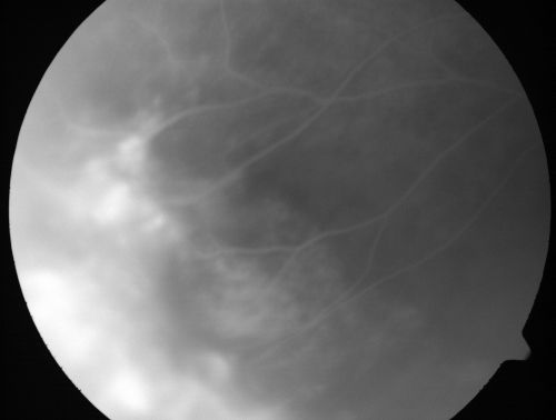 ECTOPIC DISCIFORM SCAR/PERIPHERAL CHOROIDAL NEOVASCULAR MEMBRANE â€“ EXUDATE â€“INFLAMMATION IN REACTION TO THE PERIPHERAL VASCULAR LESION 
53-year-old woman has noticed some blurred vision in the right eye for a few years.  In retrospect, she thinks it is possible since she was a teenager the right eye was always the weaker eye and that the left eye has always been the better eye.  VISUAL ACUITY:  Vision OD is 20/400
