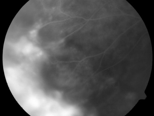 ECTOPIC DISCIFORM SCAR/PERIPHERAL CHOROIDAL NEOVASCULAR MEMBRANE â€“ EXUDATE â€“INFLAMMATION IN REACTION TO THE PERIPHERAL VASCULAR LESION 
53-year-old woman has noticed some blurred vision in the right eye for a few years.  In retrospect, she thinks it is possible since she was a teenager the right eye was always the weaker eye and that the left eye has always been the better eye.  VISUAL ACUITY:  Vision OD is 20/400
