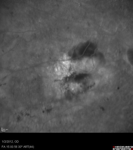 Post-Retinal Detachment Repair Occult Subfoveal CNVM
This pleasant 56-year-old man has had a complex retinal detachment repair in the right eye.  I most recently removed his silicone oil 3 months ago.  His vision now is the best it has ever been. 
VISUAL ACUITY:  OD 4/200
